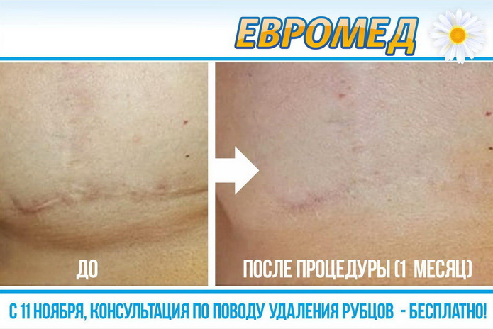 Жизнь без шрамов - PR