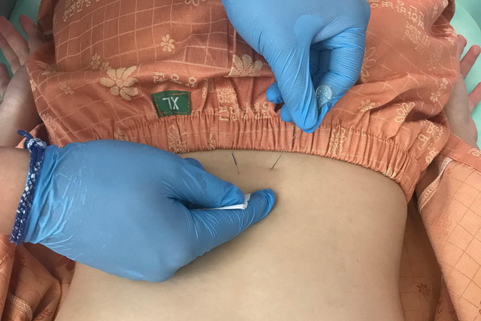 Результаты без операции - PR