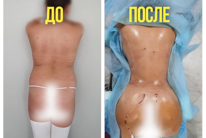 Безопасный метод липоскульптинга в Усть-Каменогорске! - PR