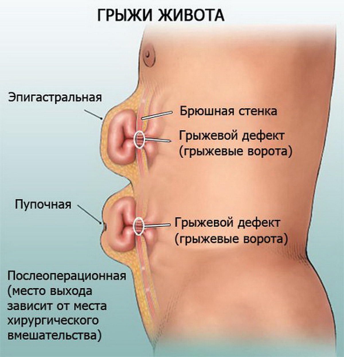 Усть-Каменогорск – Где лечить грыжи живота в Усть-Каменогорске