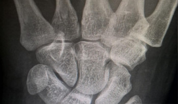 Больше 600 человек травмированы из-за гололёда в Усть-Каменогорске