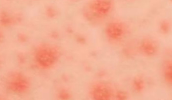 Минздрав обратился к родителям из-за роста заболеваемости корью