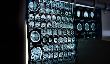 В ВКО онкозаболевания все чаще диагностируют на ранних стадиях